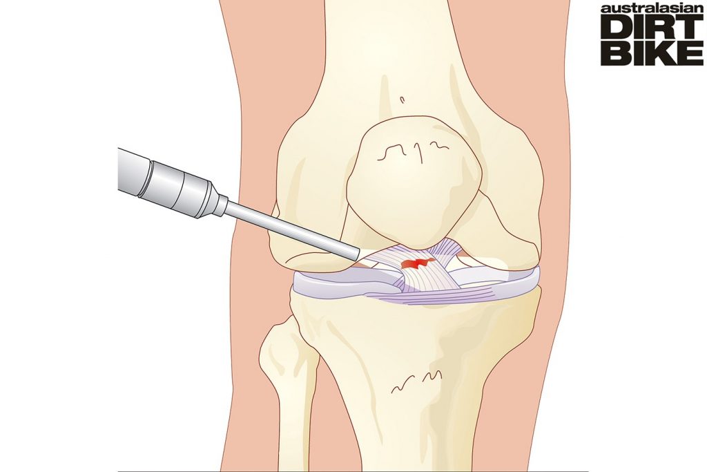 Knee injuries